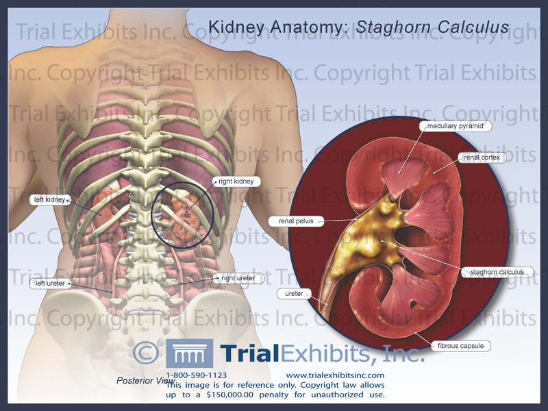 Laparoscopic Pyelolithotomy